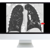 Tumor Imaging: Lung Cancer (Course)