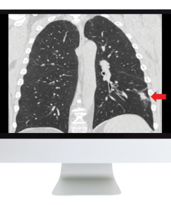 Tumor Imaging: Lung Cancer (Course)