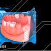 OHI-S Veneers, inlay, onlay, crowns: full protocols