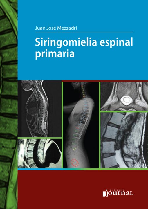 Siringomielia espinal primaria (High Quality Image PDF)