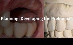 Spear-Implant Treatment Planning: Developing the Preliminary Restorative Plan