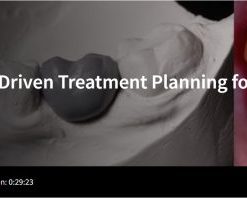 SpearProsthetically Driven Treatment Planning for Implants