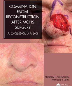 Combination Facial Reconstruction after Mohs Surgery (EPUB eBook)