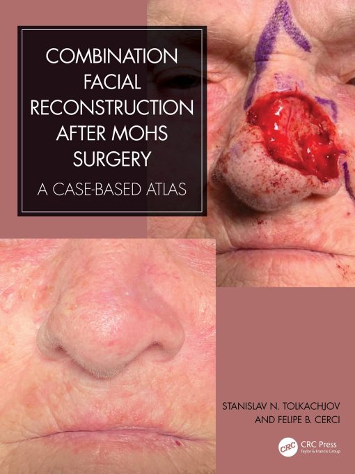 Combination Facial Reconstruction after Mohs Surgery (EPUB eBook)