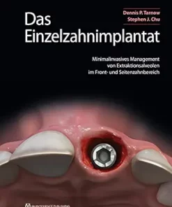 Das Einzelzahnimplantat: Minimalinvasives Management von Extraktionsalveolen im Front- und Seitenzahnbereich (German Edition) (EPUB)