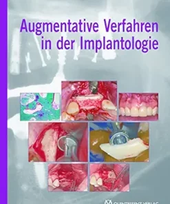 Augmentative Verfahren in der Implantologie (German Edition) (EPUB)