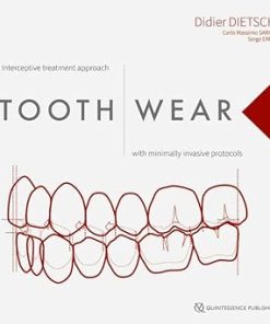 Tooth Wear: Interceptive Treatment Approach With Minimally Invasive Protocols (PDF)