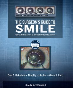 The Surgeon’s Guide to SMILE (PDF)