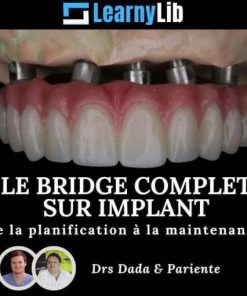 LearnyLib Le Bridge Complet sur Implant – Dada, Pariente de la plantification a la maintenance (Dental course)