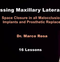 Missing Maxillary Lateral Incisors: Space Closure in all Malocclusions vs Implants and Prosthetic Replacement (Dental course)