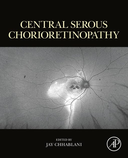 Central Serous Chorioretinopathy (PDF)