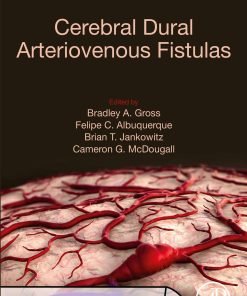 Cerebral Dural Arteriovenous Fistulas (EPUB)