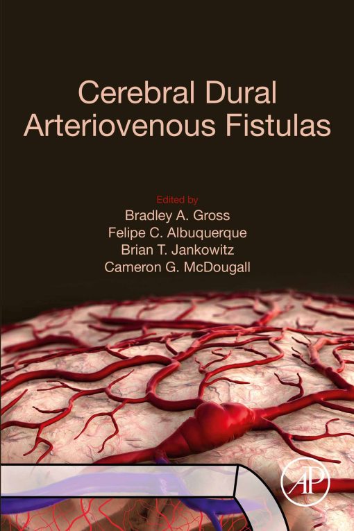 Cerebral Dural Arteriovenous Fistulas (EPUB)