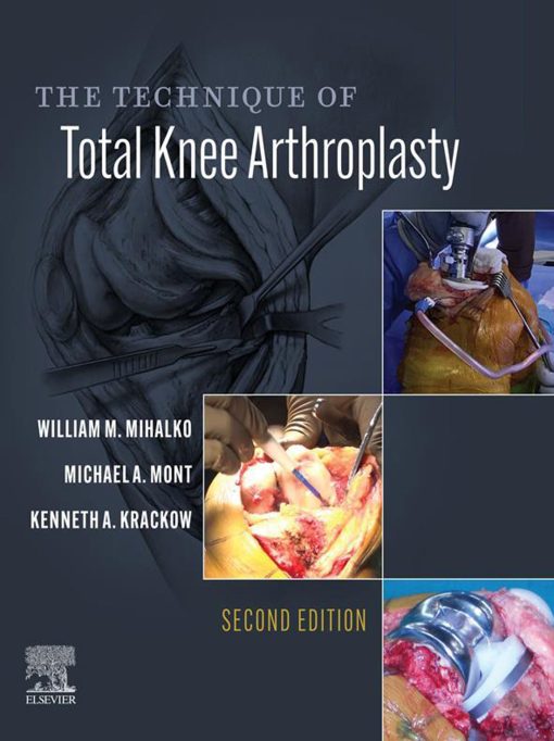 The Technique Of Total Knee Arthroplasty, 2nd Edition (EPUB)