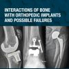 Interactions Of Bone With Orthopedic Implants And Possible Failures (PDF)