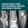 Interactions Of Bone With Orthopedic Implants And Possible Failures (EPUB)