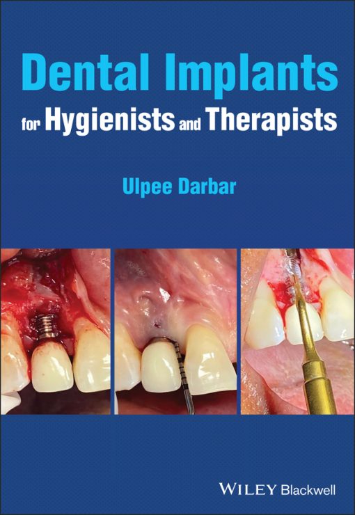 Dental Implants For Hygienists And Therapists (EPUB)