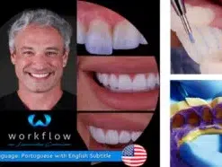 Ceramic Veneers Workflow