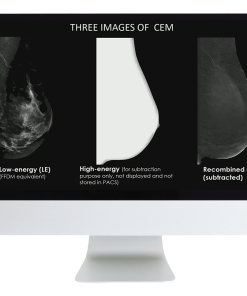 Contrast Enhanced Mammography: The Essentials and Beyond