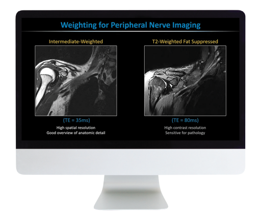 MR Neurography and NS-RADS: Assist Your Neuropathy and Pain Patients