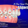 Anterior Implant Esthetic Restorations