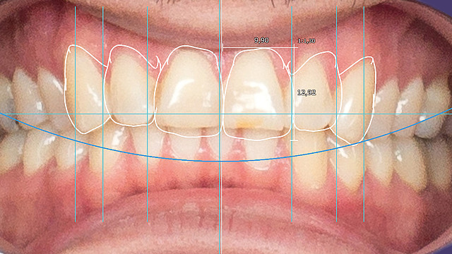 Advanced EXOCAD for All the Things AOX