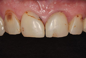 Comprehensive Guide to Composite Veneers