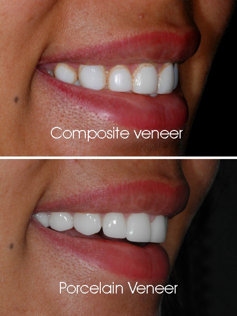 Comprehensive Guide to Composite Veneers