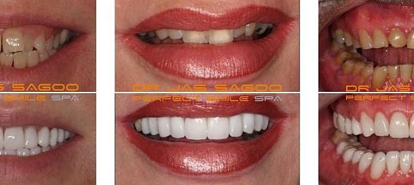 Comprehensive Guide to Composite Veneers