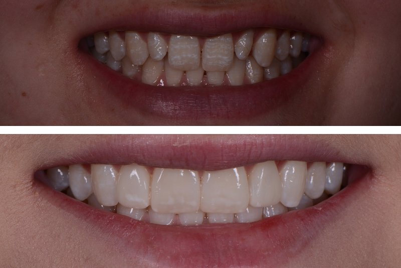 Comprehensive Guide to Composite Veneers