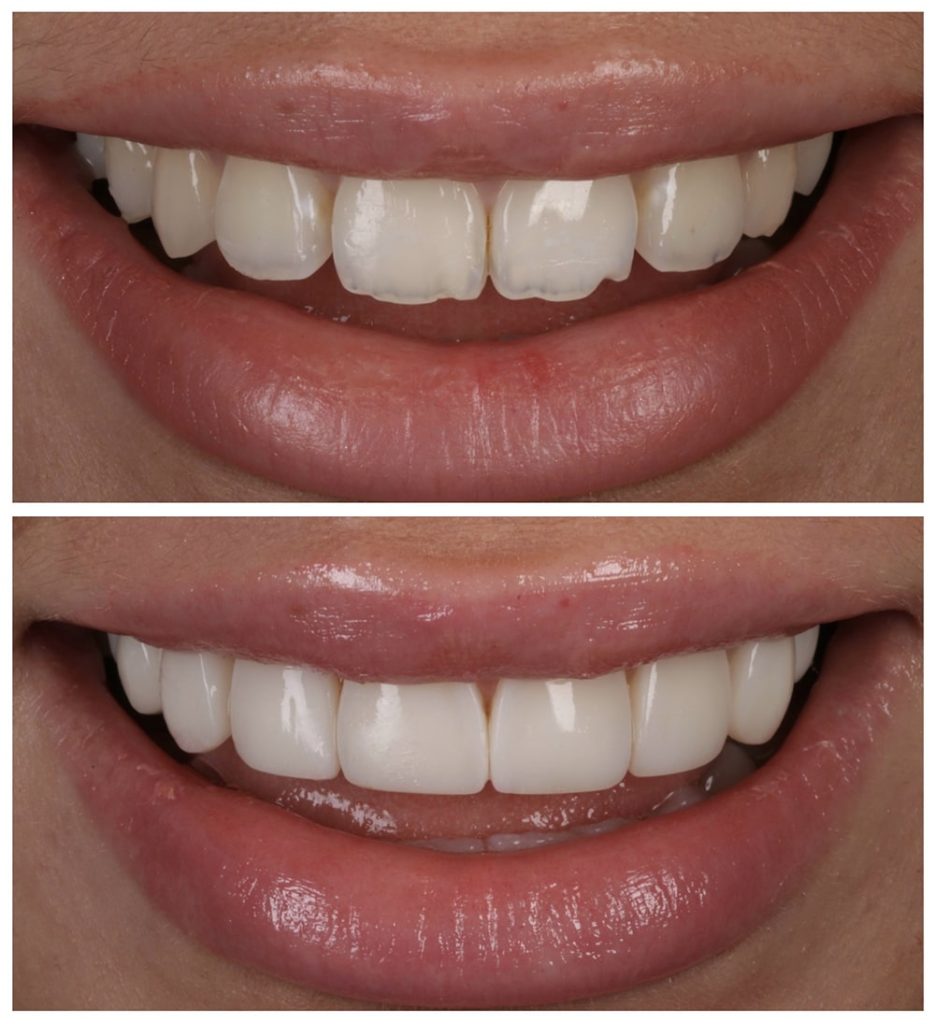 Comprehensive Guide to Composite Veneers