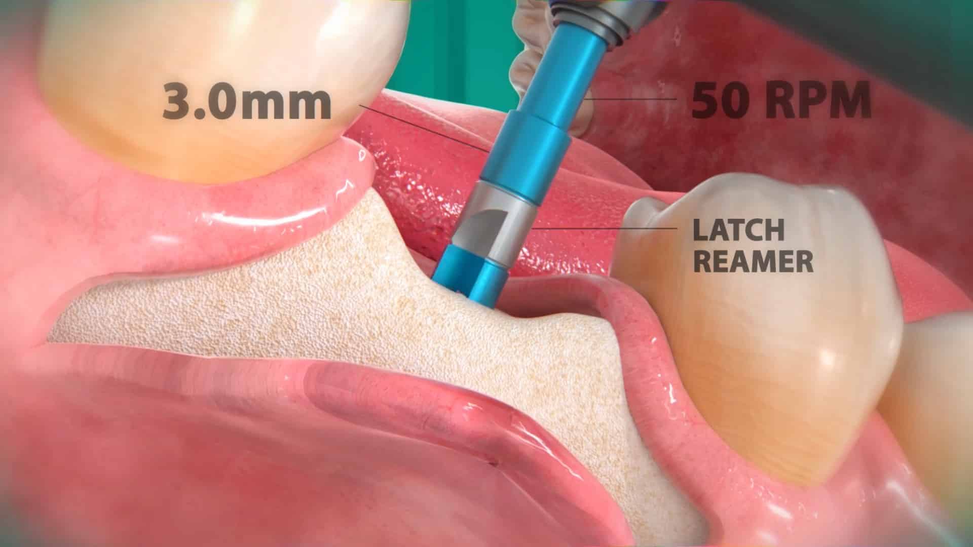 10 Essential Fundamentals of Implant Dentistry: 2024 Comprehensive Guide