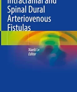 Intracranial And Spinal Dural Arteriovenous Fistulas (PDF)