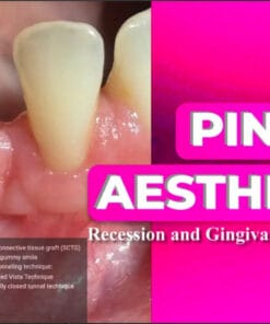 OHI-S Pink Aesthetics, Recession and Gingival Smile Treatment