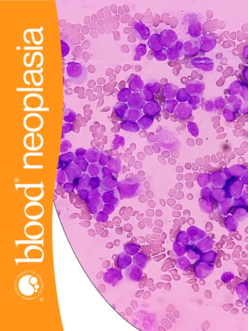 Blood Neoplasia PDF