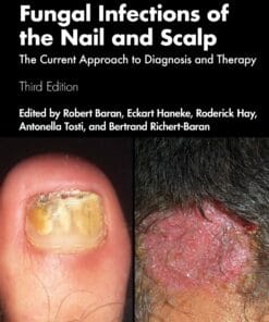 Fungal Infections Of The Nail And Scalp: The Current Approach To Diagnosis And Therapy, 3rd Edition (PDF)