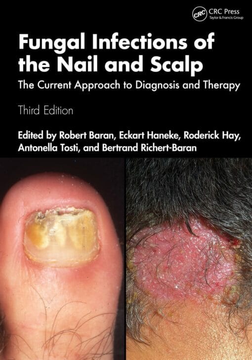 Fungal Infections Of The Nail And Scalp: The Current Approach To Diagnosis And Therapy, 3rd Edition (PDF)