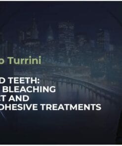 Discolored teeth: combining bleaching with direct and indirect adhesive treatments