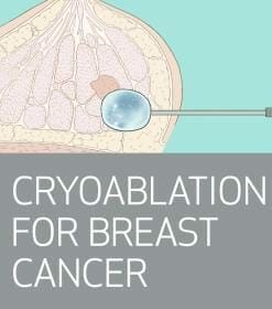 Houston Methodist Breast Cryoablation & Biopsy MRI, Ultrasound and Stereotactic Guidance 2024