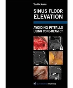 Sinus Floor Elevation: Avoiding Pitfalls Using Cone-beam CT (Scanned PDF)