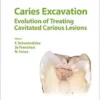 Caries Excavation: Evolution of Treating Cavitated Caries Lesions (Monographs In Oral Science) (EPUB)