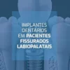 Implantes dentários em pacientes fissurados labiopalatais (Portuguese Edition) (EPUB)