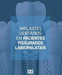 Implantes dentários em pacientes fissurados labiopalatais (Portuguese Edition) (EPUB)