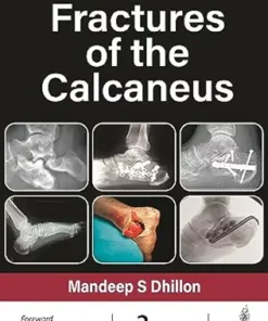 Fractures of the Calcaneus, 2nd Edition (PDF)
