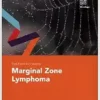 Fast Facts for Patients: Marginal Zone Lymphoma (PDF)