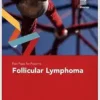 Fast Facts for Patients: Follicular Lymphoma (EPUB)