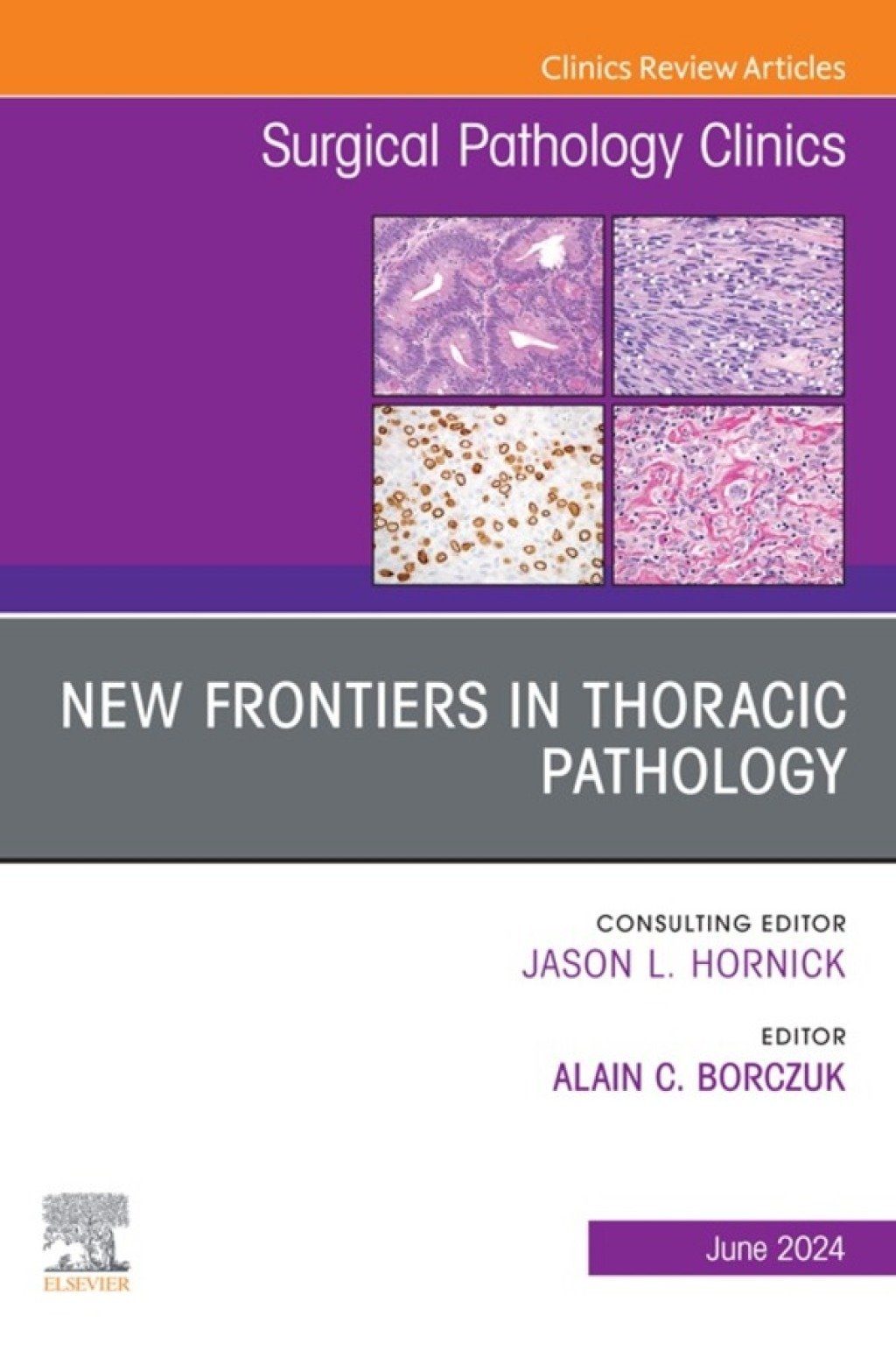 New Frontiers in Thoracic Pathology, An Issue of Surgical Pathology Clinics (True PDF ) New Frontiers in Thoracic Pathology, An Issue of Surgical Pathology Clinics (True PDF )