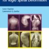 Corrective Osteotomies for Rigid Spinal Deformities (EPUB) Corrective Osteotomies for Rigid Spinal Deformities (EPUB)