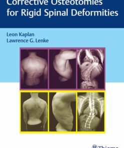 Corrective Osteotomies for Rigid Spinal Deformities (EPUB)