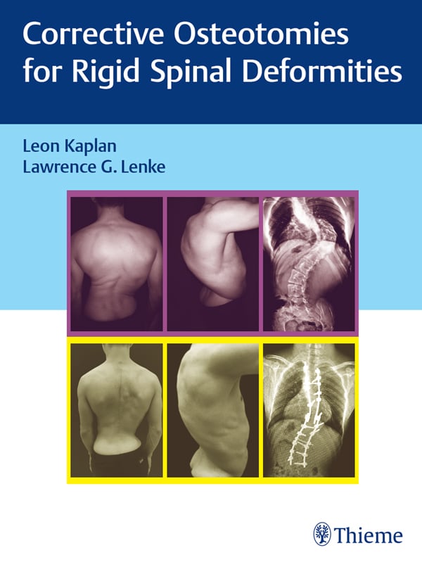 Corrective Osteotomies for Rigid Spinal Deformities (EPUB) Corrective Osteotomies for Rigid Spinal Deformities (EPUB)